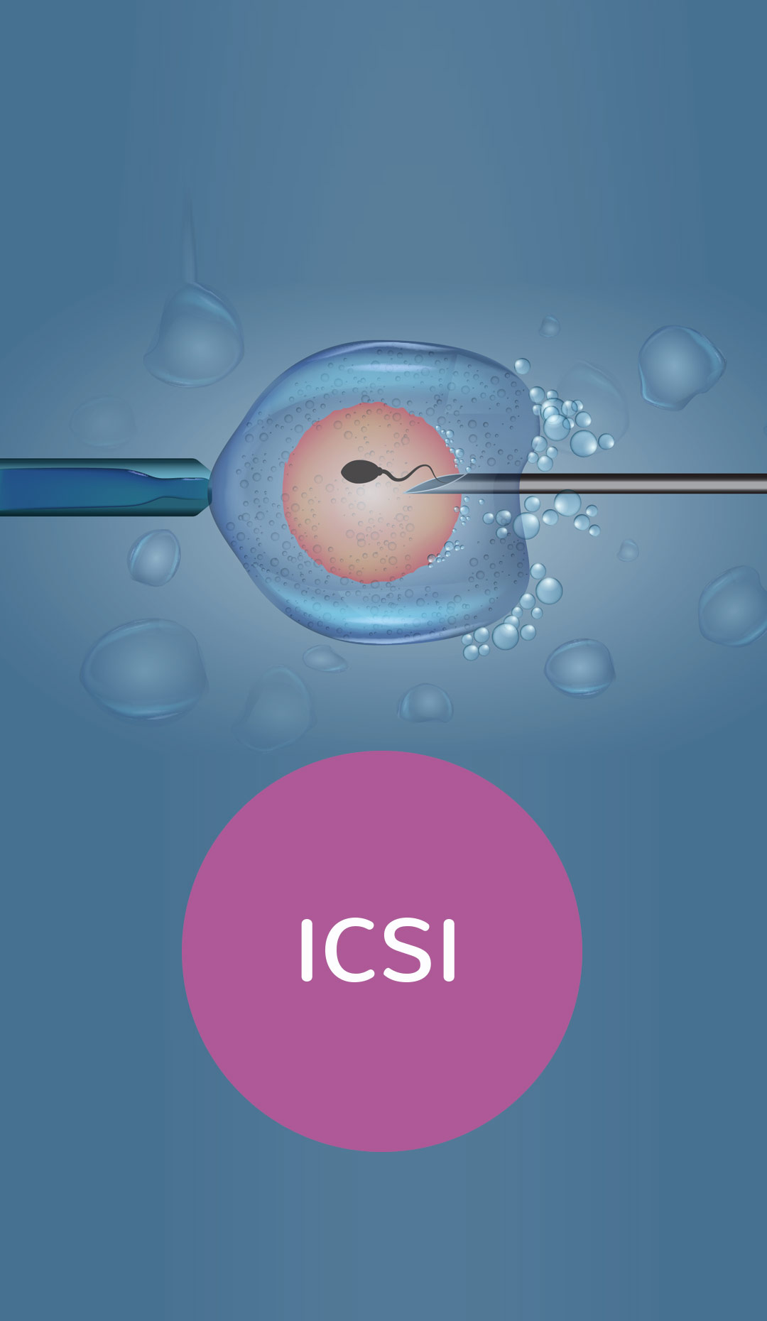 ICSI Clinic in Hyderabad
