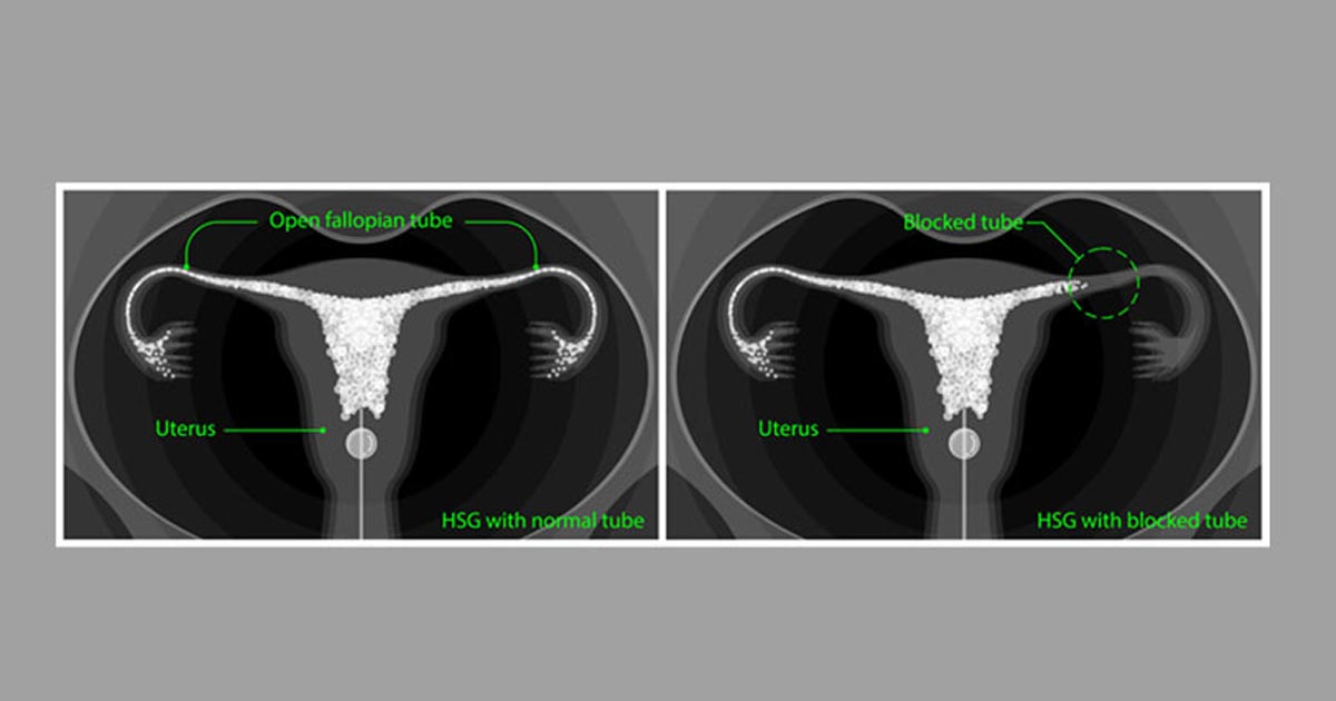 tubal-infertility-treatment-tubal-factor-infertility